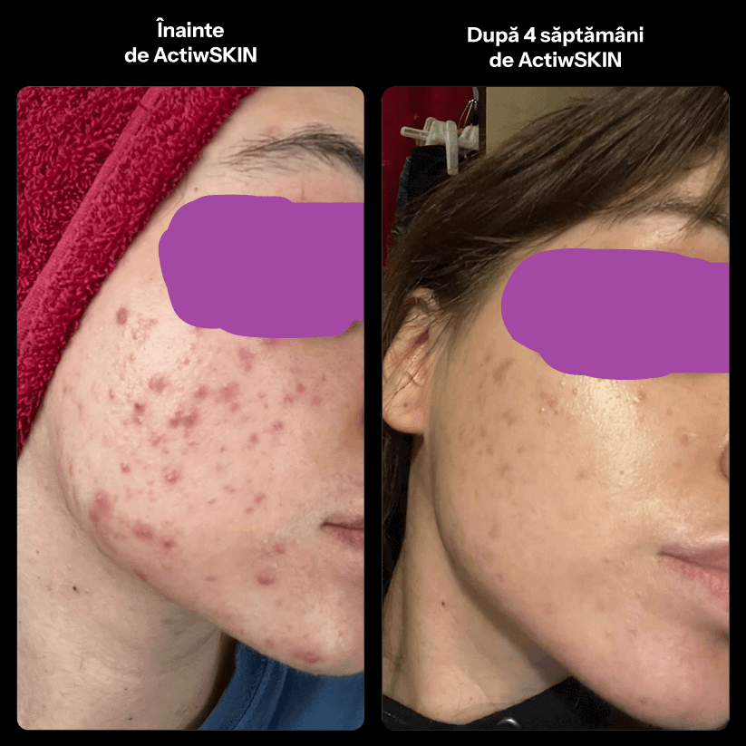 ActiW SKIN - PENTRU ACNEE - Pachet mic - Tratament 12-15 zile
