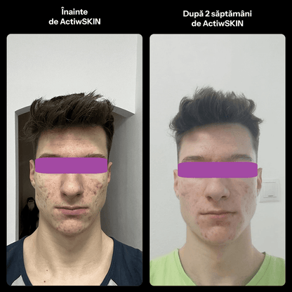 ActiW SKIN - PENTRU ACNEE - Pachet mic - Tratament 12-15 zile